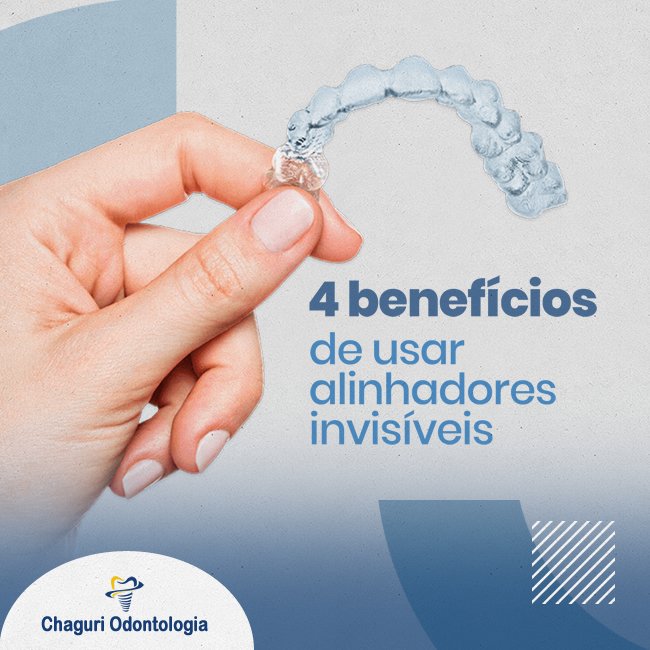 4 BENEFÍCIOS DE USAR ALINHADORES INVISÍVEIS