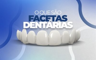 O QUE SÃO FACETAS DENTÁRIAS?