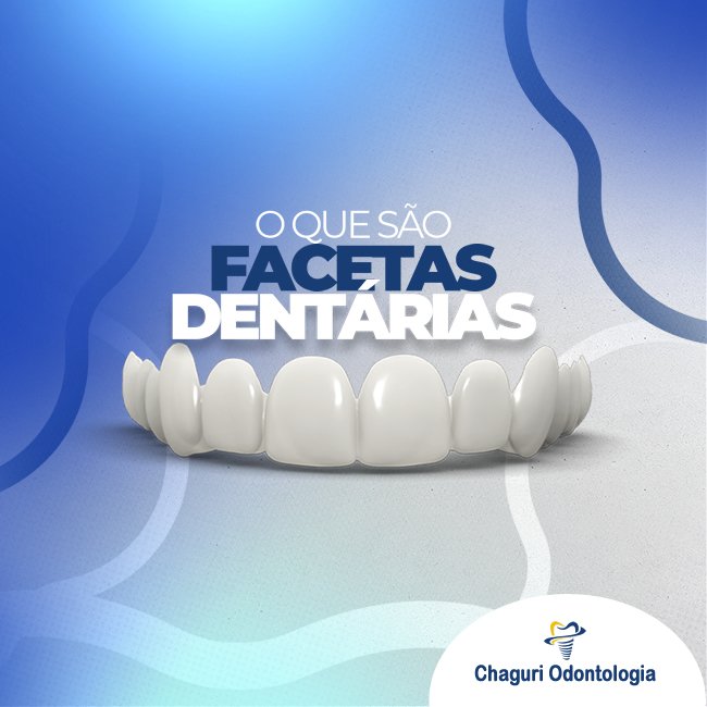 O QUE SÃO FACETAS DENTÁRIAS?