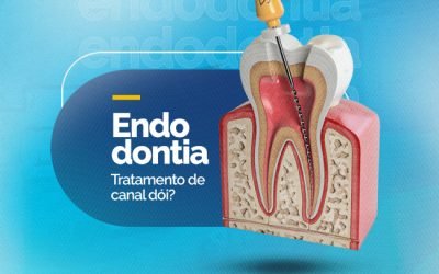 ENDODONTIA – TRATAMENTO DE CANAL DÓI?