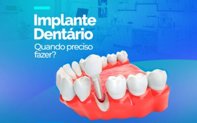 IMPLANTE DENTÁRIO – QUANDO PRECISO FAZER?