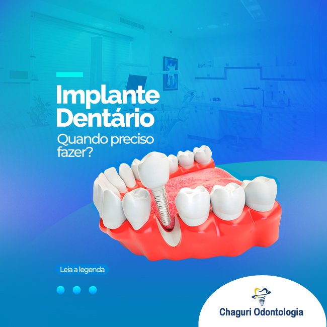 IMPLANTE DENTÁRIO – QUANDO PRECISO FAZER?