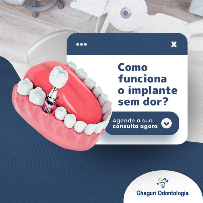 COMO FUNCIONA O IMPLANTE SEM DOR?
