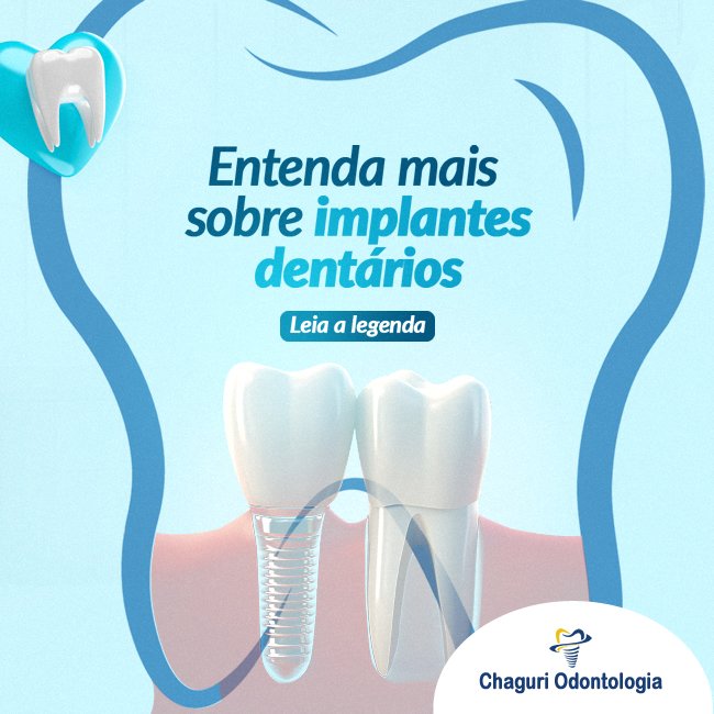 ENTENDA MAIS SOBRE IMPLANTES DENTÁRIOS